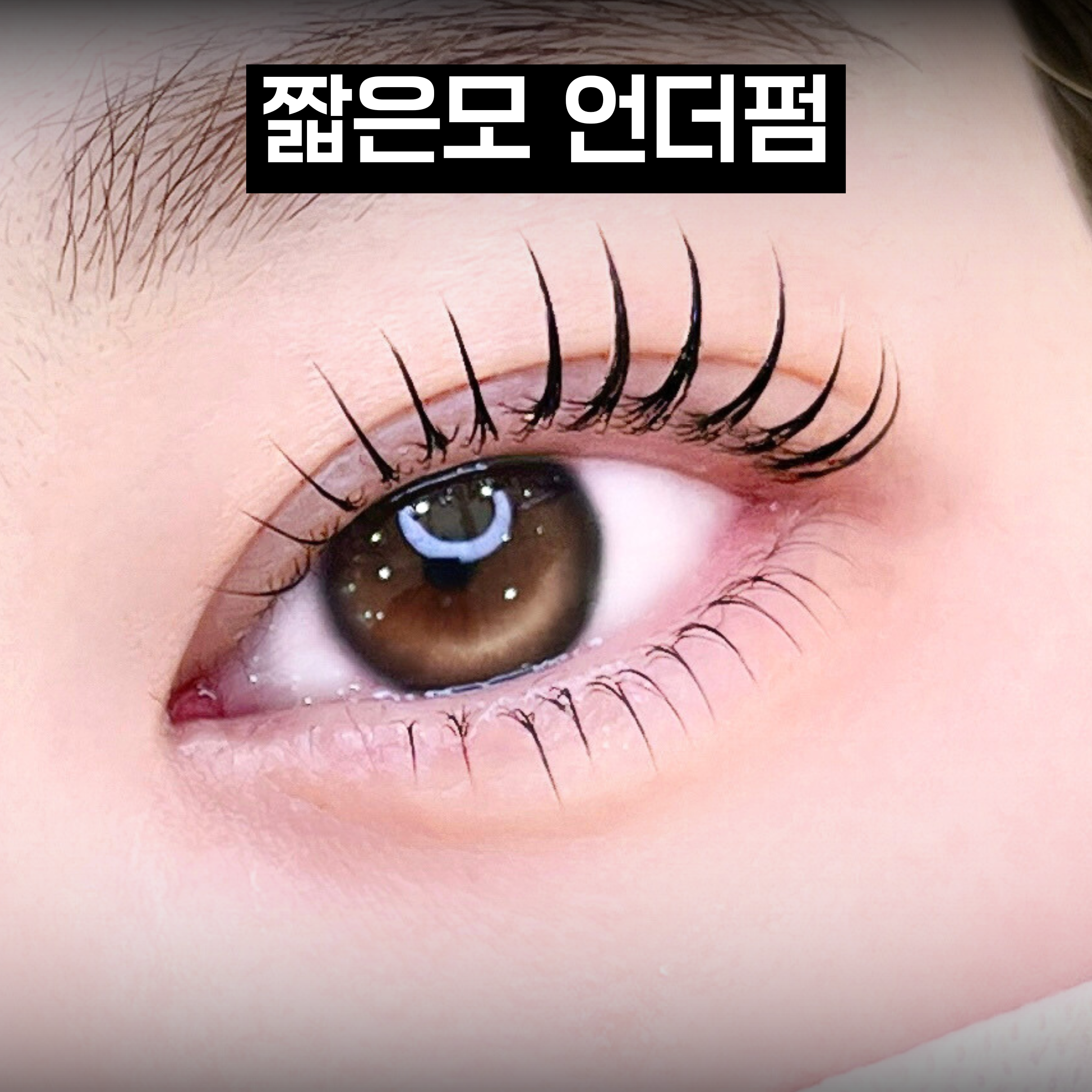 언더펌 시술 결과 5